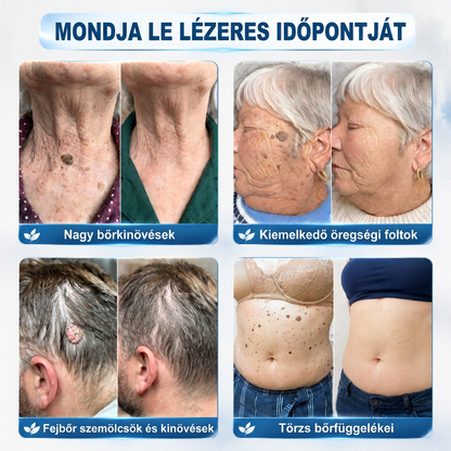𝐇𝐈𝐒𝐊𝐈𝐍®👩‍⚕️ 𝟕 𝐍𝐚𝐩𝐨𝐬 𝐁ő𝐫𝐜𝐢𝐦𝐤𝐞 & 𝐅𝐨𝐥𝐭 𝐄𝐥𝐭á𝐯𝐨𝐥í𝐭ó 𝐑𝐨𝐥𝐥𝐞𝐫 𝐓𝐨𝐥𝐥 Fájdalommentes és heg nélküli, fejlett bőrhibák eltávolítására szolgáló görgős toll