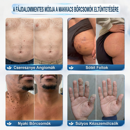 𝐇𝐈𝐒𝐊𝐈𝐍®👩‍⚕️ 𝟕 𝐍𝐚𝐩𝐨𝐬 𝐁ő𝐫𝐜𝐢𝐦𝐤𝐞 & 𝐅𝐨𝐥𝐭 𝐄𝐥𝐭á𝐯𝐨𝐥í𝐭ó 𝐑𝐨𝐥𝐥𝐞𝐫 𝐓𝐨𝐥𝐥 Fájdalommentes és heg nélküli, fejlett bőrhibák eltávolítására szolgáló görgős toll