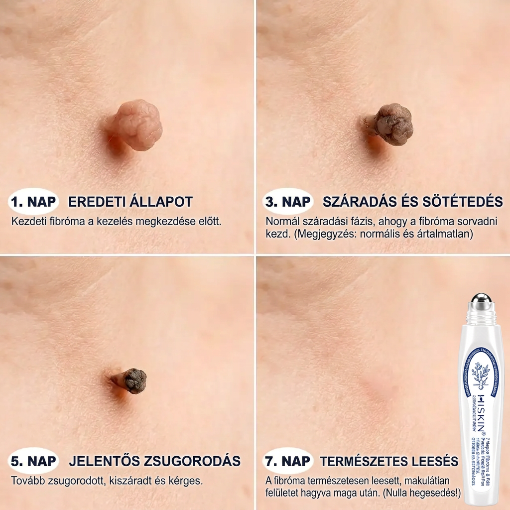 𝐇𝐈𝐒𝐊𝐈𝐍®👩‍⚕️ 𝟕 𝐍𝐚𝐩𝐨𝐬 𝐁ő𝐫𝐜𝐢𝐦𝐤𝐞 & 𝐅𝐨𝐥𝐭 𝐄𝐥𝐭á𝐯𝐨𝐥í𝐭ó 𝐑𝐨𝐥𝐥𝐞𝐫 𝐓𝐨𝐥𝐥 Fájdalommentes és heg nélküli, fejlett bőrhibák eltávolítására szolgáló görgős toll
