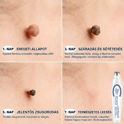 𝐇𝐈𝐒𝐊𝐈𝐍®👩‍⚕️ 𝟕 𝐍𝐚𝐩𝐨𝐬 𝐁ő𝐫𝐜𝐢𝐦𝐤𝐞 & 𝐅𝐨𝐥𝐭 𝐄𝐥𝐭á𝐯𝐨𝐥í𝐭ó 𝐑𝐨𝐥𝐥𝐞𝐫 𝐓𝐨𝐥𝐥 Fájdalommentes és heg nélküli, fejlett bőrhibák eltávolítására szolgáló görgős toll